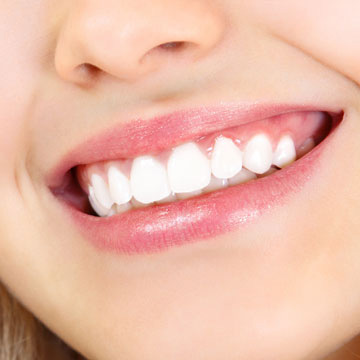 Veneers